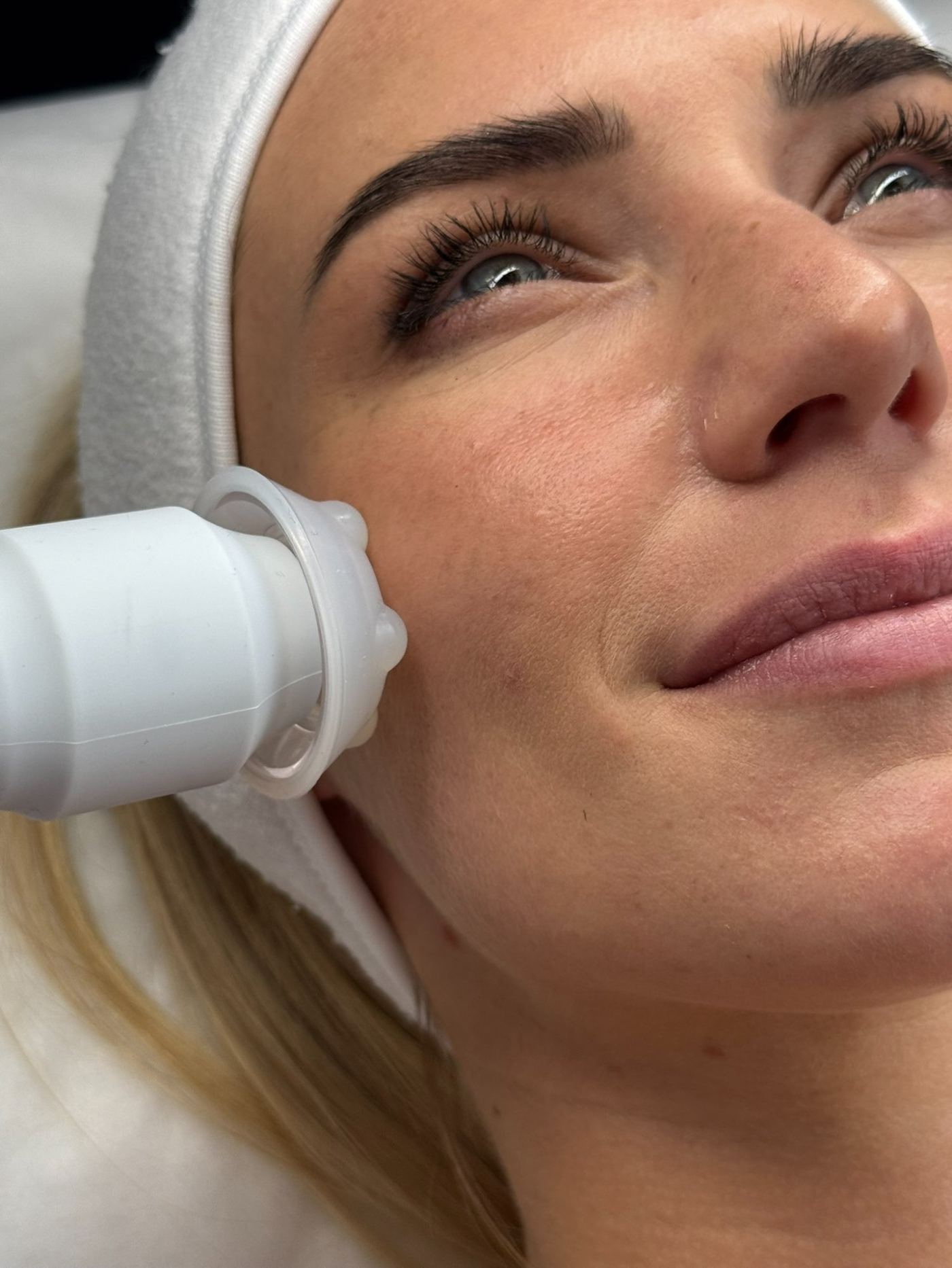 Hydropeeling pommette Laser Ligne