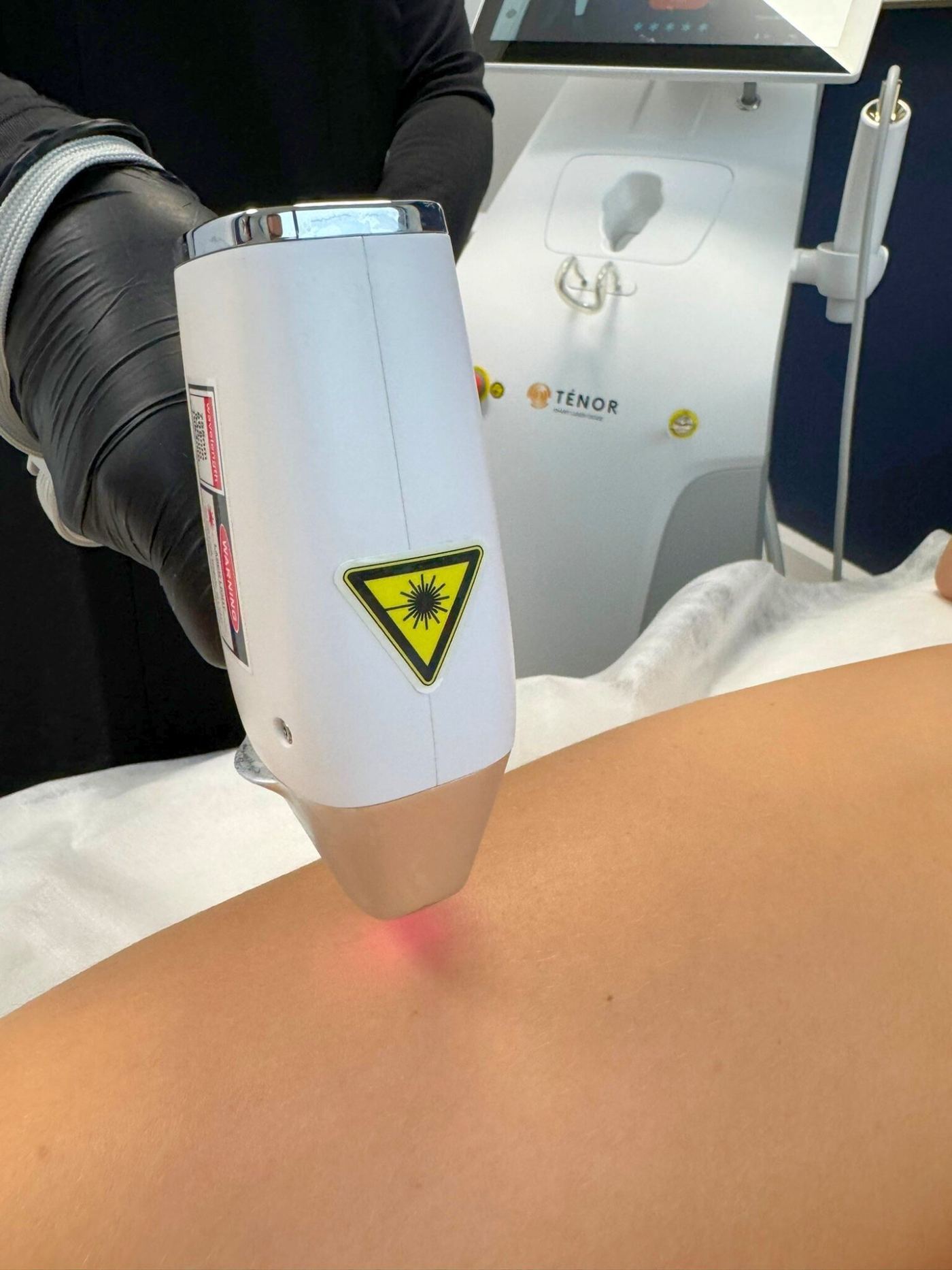 Séance épilation laser dos femme à Groslay (95) — Laser Ligne