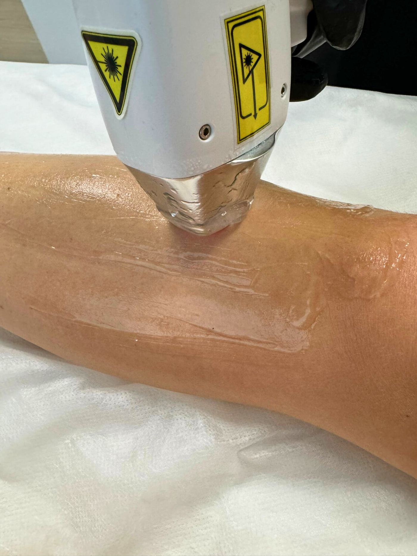 Épilation laser aisselle Laser Ligne