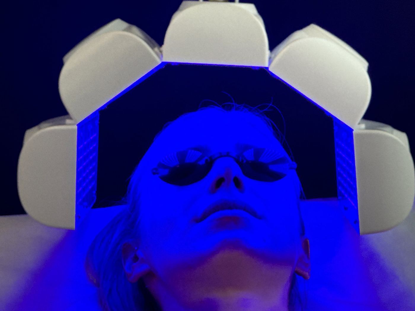 LED bleue photomodulation anti-acné Laser Ligne