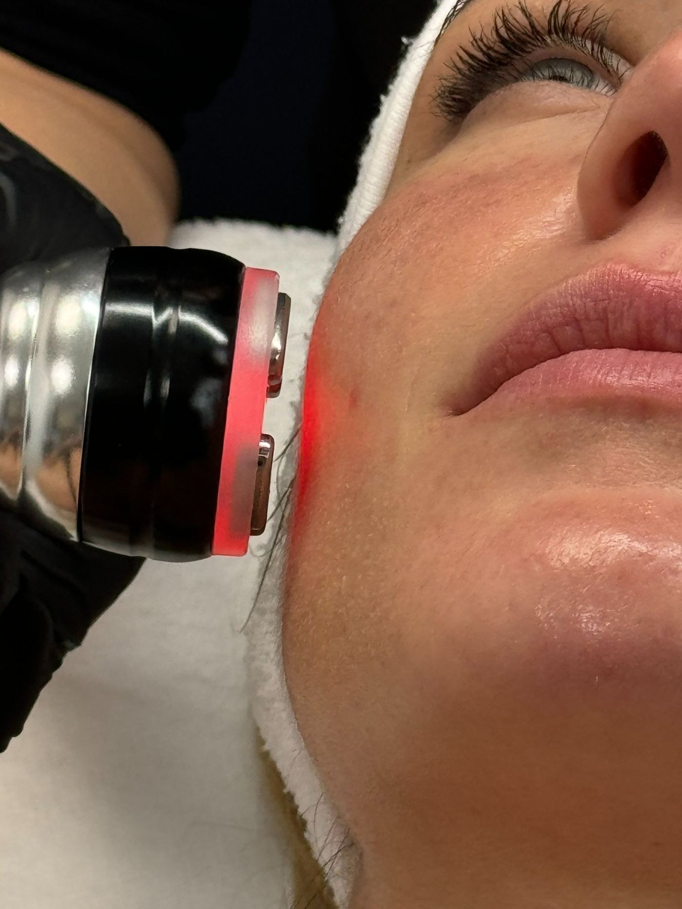 Traitement antirides Laser Ligne