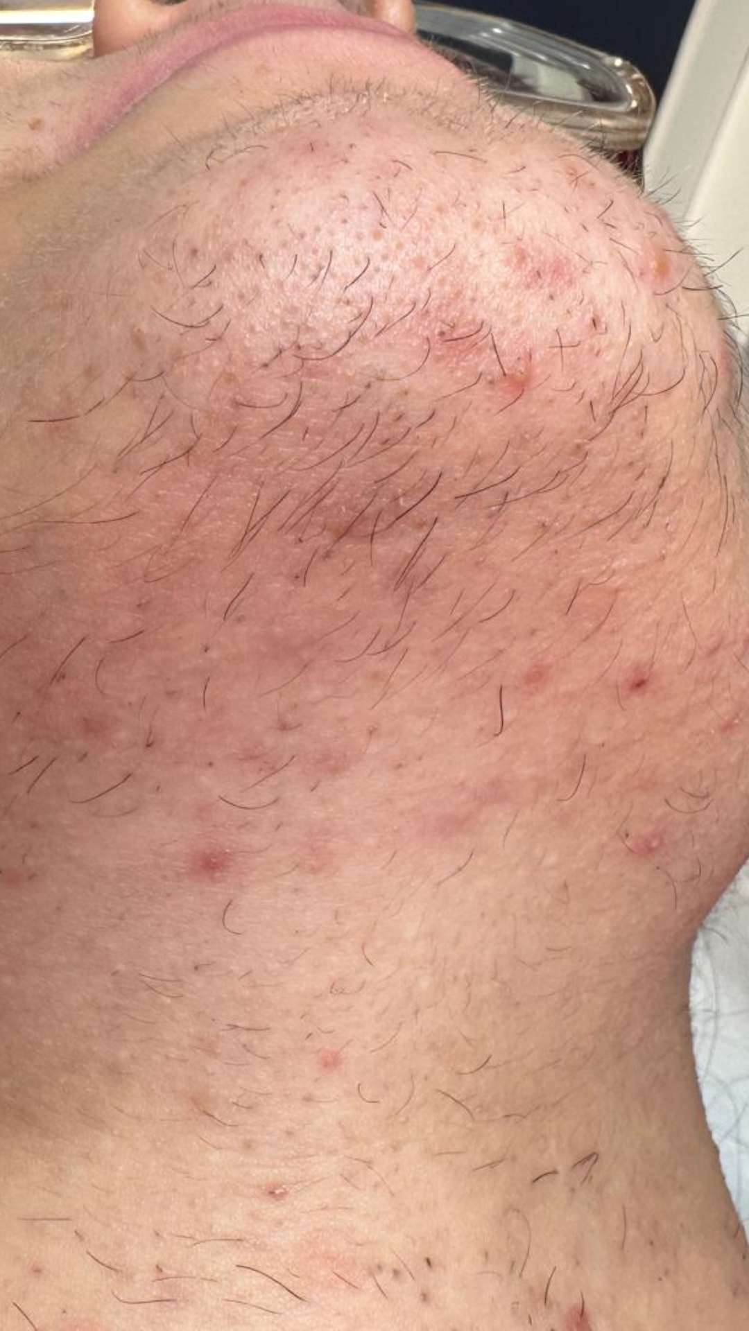 Après thermolyse barbe poils incarnés visage — Laser Ligne Groslay