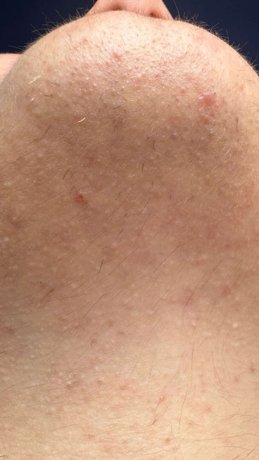 Avant thermolyse barbe poils incarnés visage — Laser Ligne Groslay