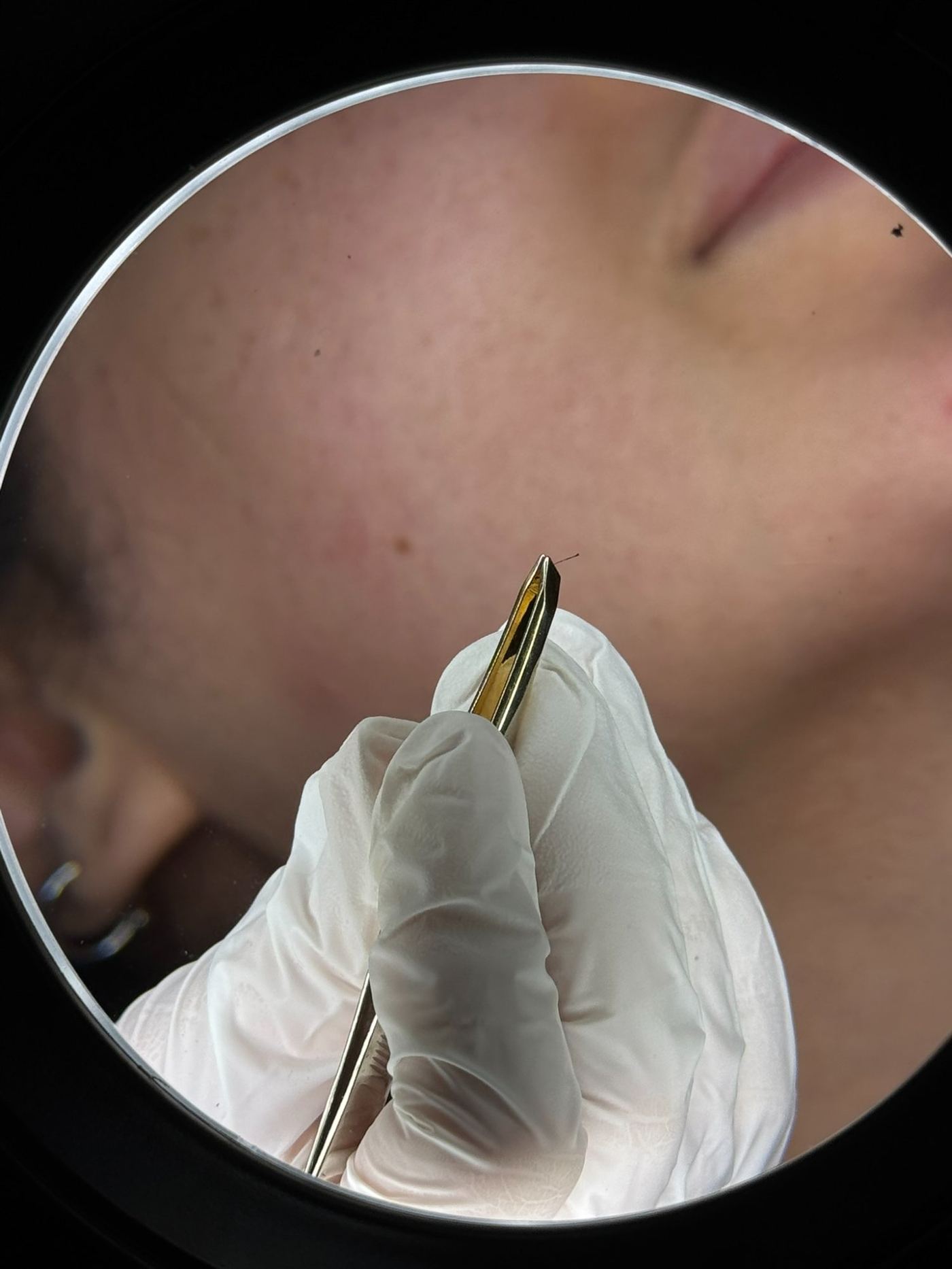 Thermolyse visage sous loupe Laser Ligne Groslay